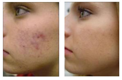 Acne Scar Removal with Chemical Peels