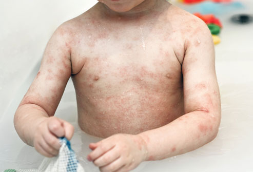 How to Treat Childhood Atopic Dermatitis